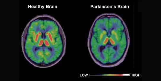 Parkinson's Disease An Overview2