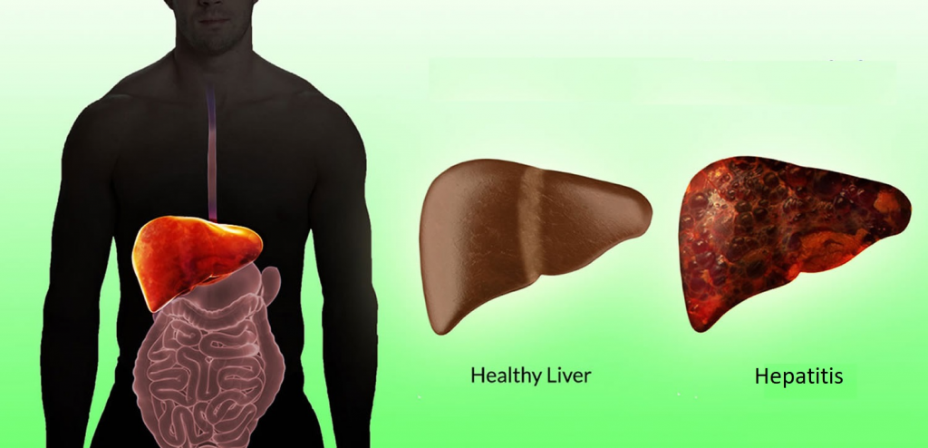 Save Your Liver From Hepatitis2