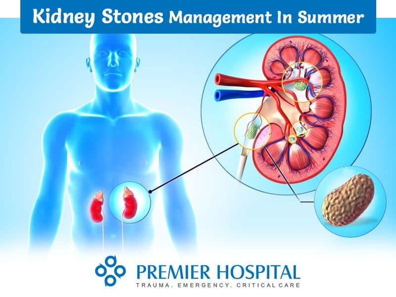 Kidney Stones Management in Summer