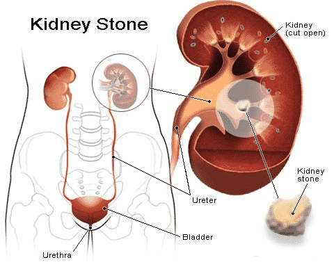 Kidney Stones Management in Summer2