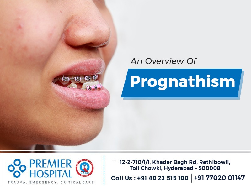 Mandibular Prognathism- The Royal Jaw