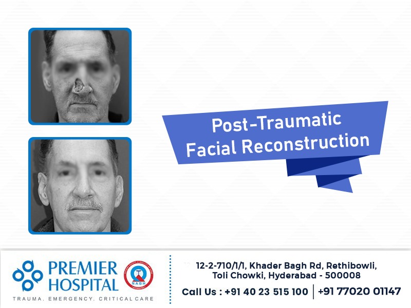 Post-Traumatic Facial Reconstruction