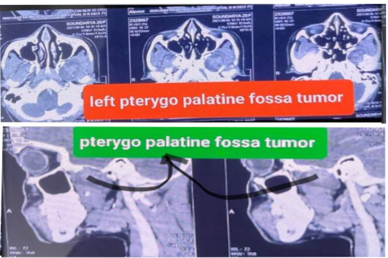 Pterygopalatine-Fossa-Tumour-Management-in-premier-hospital